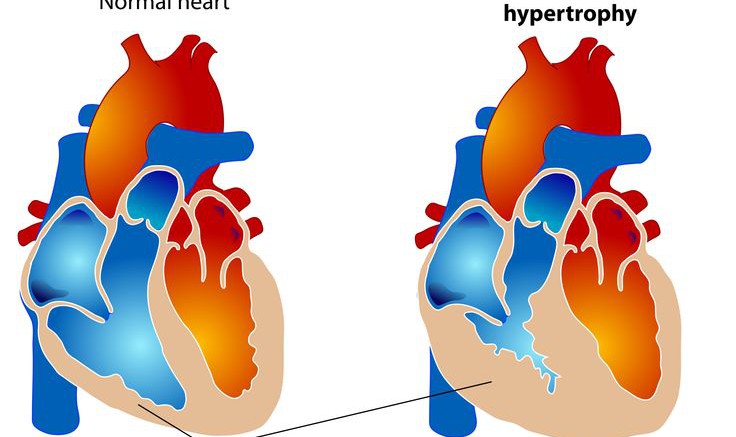 Heart disease - Wikimedia commons - Photo: Mariana Ruiz Villarreal